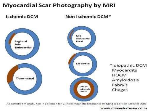 How to diagnose DCM with confidence by myocardial scar photography ...