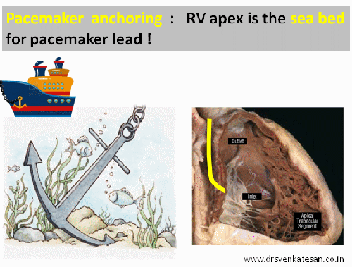 pacemaker lead in rv apex anchoring how to