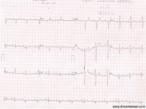ecg north west qrs axis  indeterminate