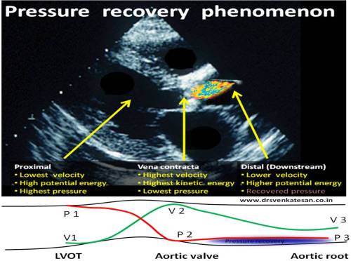 pressure recovery in aortic stenosis animation