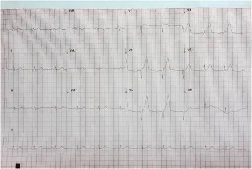 Anterior STEM ecg