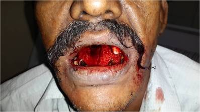 Strptokinase induced bleeding