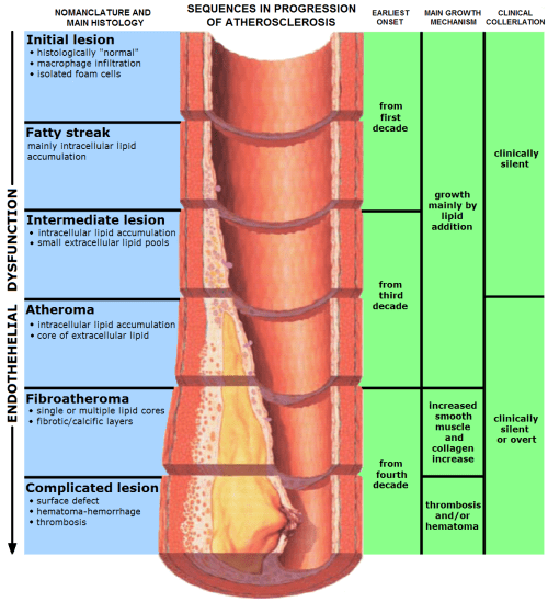 atherosclerosis flow limiting lesion glagov plaque rupture vulnerable erosion fissure vs dissection
