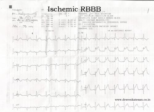 ischemic rbbb