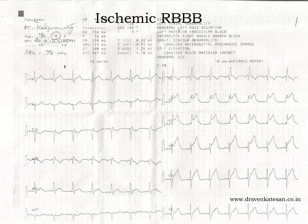 Ischemic RBBB | Dr.S.Venkatesan MD