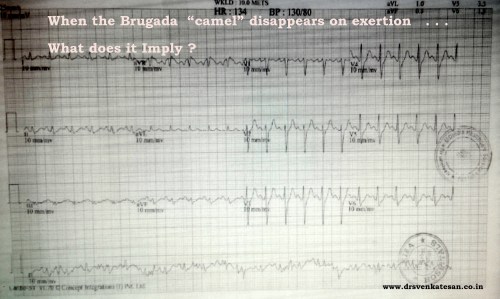 Brugada ecg camel on exertion