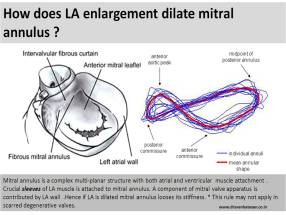 effect of la enlargement on mitral annulus