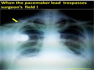 pacemaker lead clavicle fracture electro cautery surgery