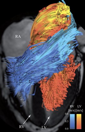 RVOT blood flow right ventricle