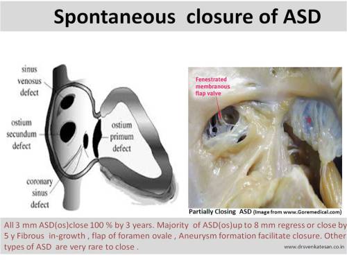 spontaneous closure of asd