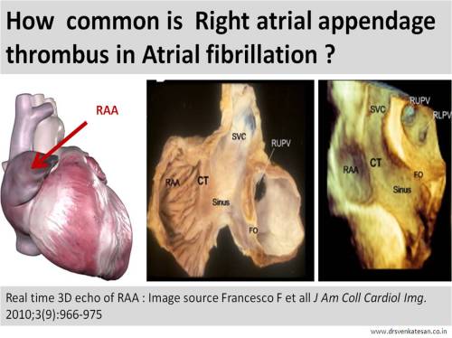 RAA right atrial appendage clot tee echocardiography