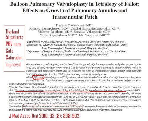 Balloon pulmonary valvotomy for tof tetrology of fallot