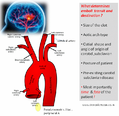 cardiac source of emboli embolus ischemic stroke animation embolic peripheral renal mesentric lerish syndrome 002