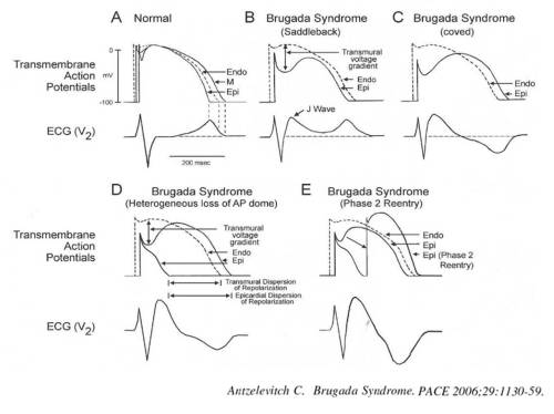 mechanism of brugada syndrome three types of ecg 2