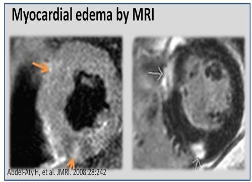 myocardial edema by mri in ckd 2