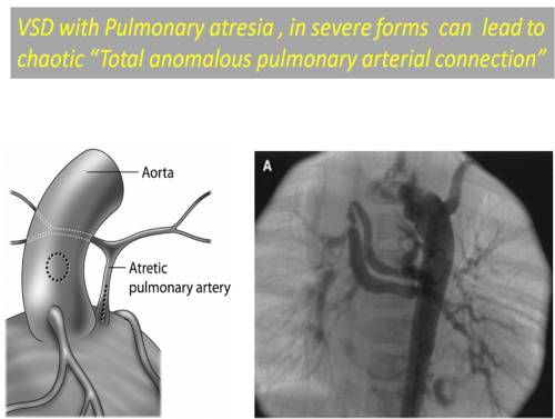 pulmonary atresia vsd mapcas major aorto pulmonary collaterlal unifocalisation single multiple stage tapac
