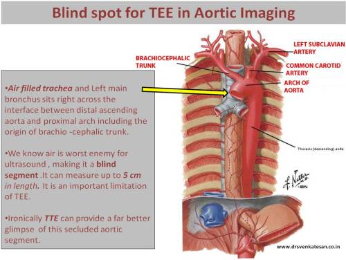 blind spot for tee in aortic imaging distal ascending aorta and proximal arch bracho cephalic trunk