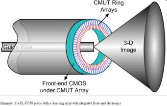 ivus forward loooking cto intervention