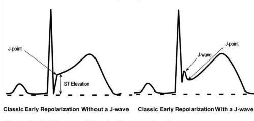 J wave and J point early repolarisation syndrome