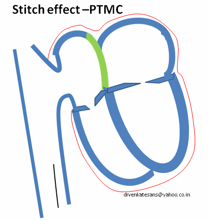 stitch effect ptmc stich phenemenon
