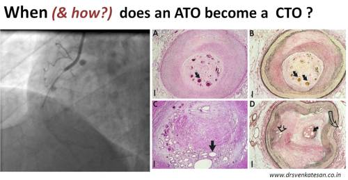 chronic total occlusion acute total coronary bridging collateral