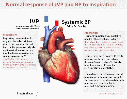effect of inspiration on jvp and bp pulsus paradoxus bernhiem effect ventricular interdependence