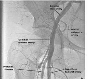 femoral artery puncture by fluroscopy 2