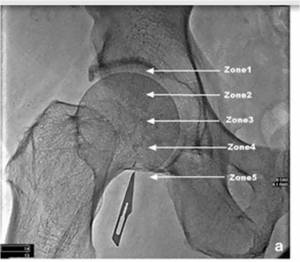 femoral artery puncture by fluroscopy