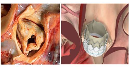 TAVI TAVR valve dislodgement embolism partent a b