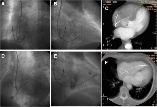 rv pacing mid septal postion rvot rv apical