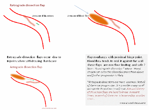 flow limiting vs non flow limiting dissection | Dr.S.Venkatesan MD