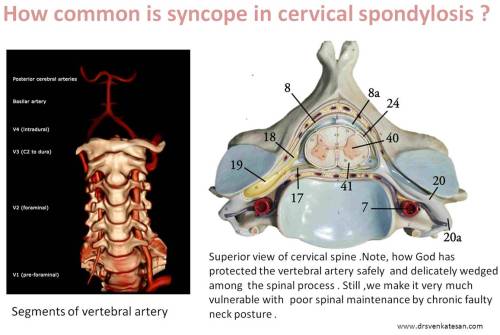 how common is suncope in cervical spondylosis