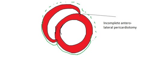 post cabg wall motion defect
