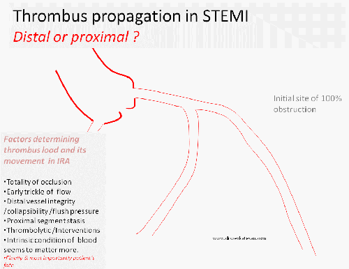 thrombus propgation