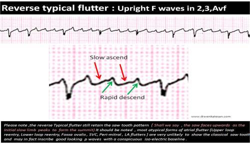 mechanism-of-flutter-wave-upright-or-inverted