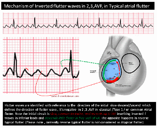 Inverted A Flutter mechanism of atrial flutter | Dr.S.Venkatesan MD