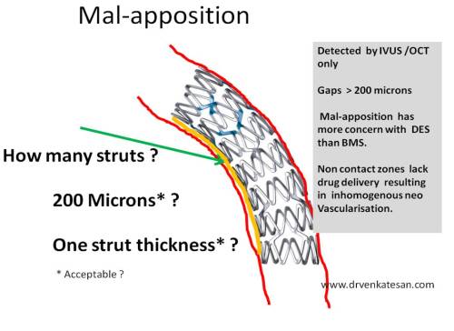 under-expanded-stent-vs-malapposition-post-dilatation-200-microns