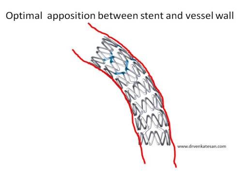under-expanded-stent-vs-malapposition-post-dilatation