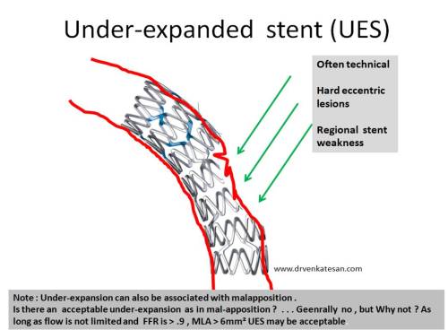 under-expanded-stent-vs-malapposition