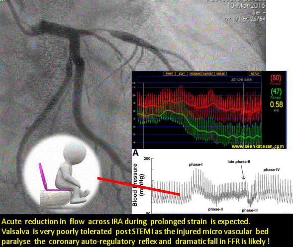 hemodynamics of ffr lad valsalva 2