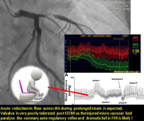 hemodynamics of ffr lad valsalva 2