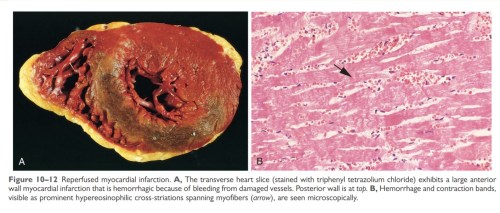 Reperfused myocardium