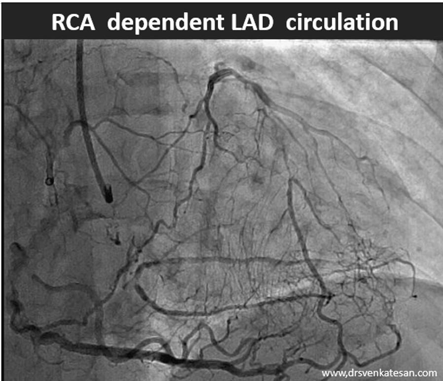 RCA dependent lad circulation