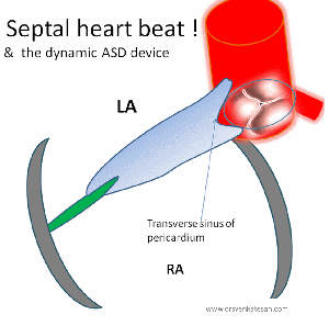 Aortic erosion following ASD device closure : A reality check ! | Dr.S ...