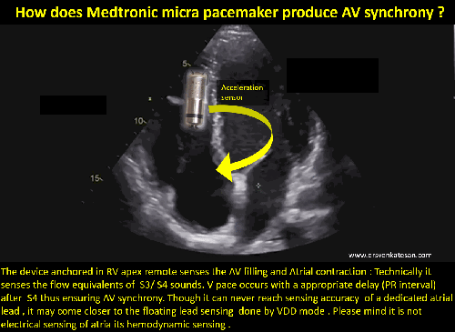 AV synchrony in lead-less Micra AV pacemaker: How does it sense Atria ...
