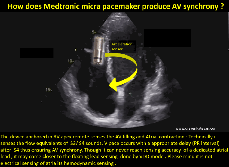 Medtronic micr AV pacing 2