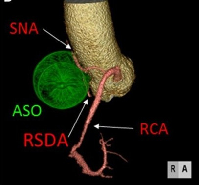 SA node compression by ASD device amplatzer