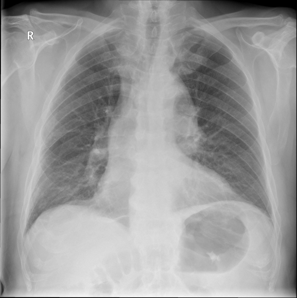 normal aorta size Dr.S.Venkatesan MD