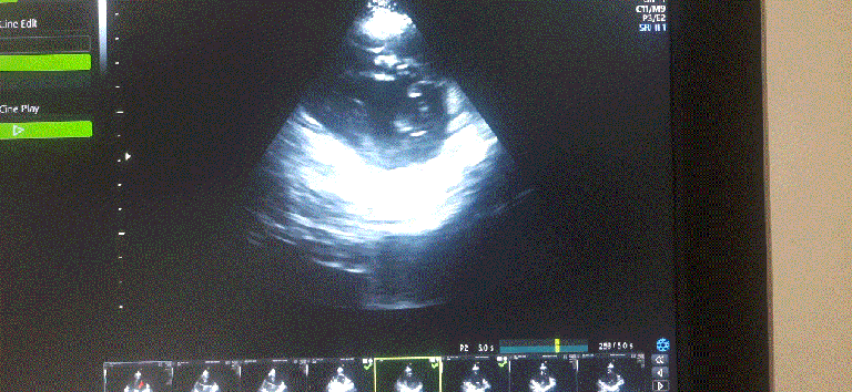 Department of artifact : Normal “wall motion defect” in ...