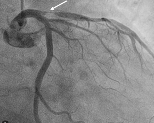 Three questions (not so simple) on a 90% LAD lesion. | Dr.S.Venkatesan MD